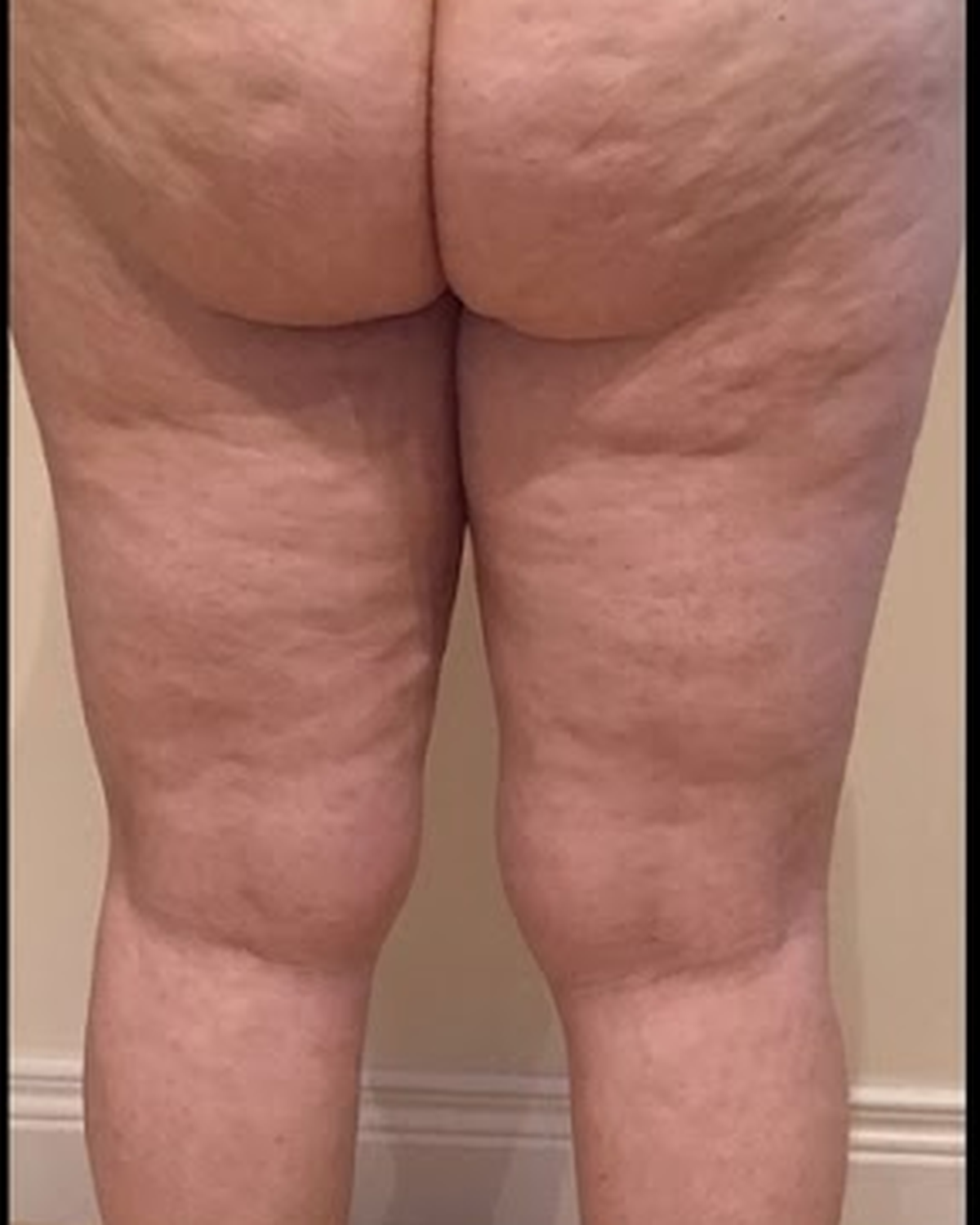Cuisses Avant
